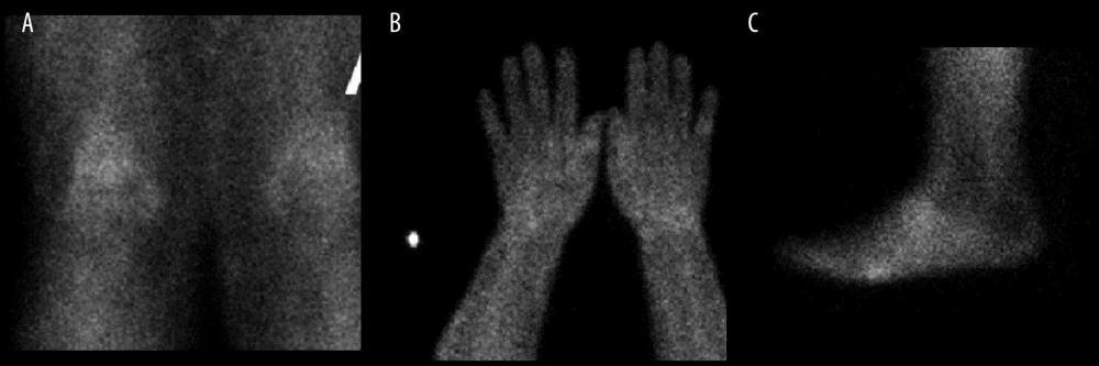 Nuclear medicine scan showing increased radio tracer uptake of case 1. (A) Bilateral knees. (B) Bilateral wrists. (C) Left foot.
