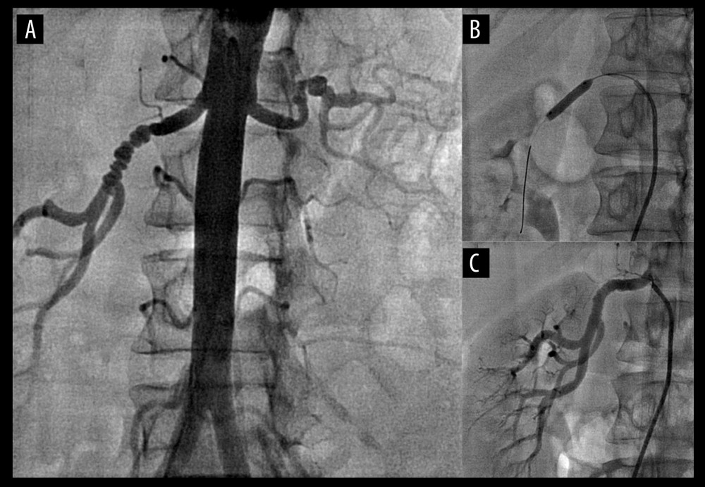 (A) FMD lesion with a classic “string of beads” appearance shows areas of stenosis and post-stenotic dilations in the right renal artery and mild stenosis and dilations in the left renal artery. (B) Balloon is dilated over an area of stenosis in the right renal artery. (C) Post-dilation image shows excellent angiographic results.