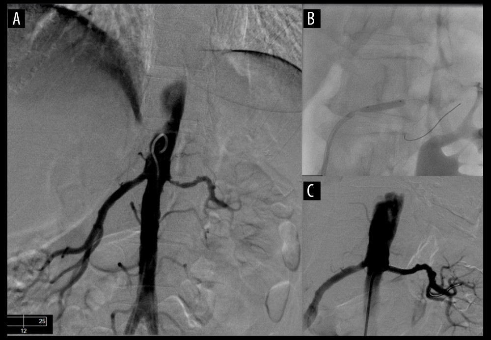 (A) Severe ostial stenosis and diffuse proximal vessel disease of the left renal artery. (B) Bare-metal stent deployment in the proximal left renal artery. (C) Post-intervention image showing no residual stenosis of the ostial and proximal segments of the left renal artery.