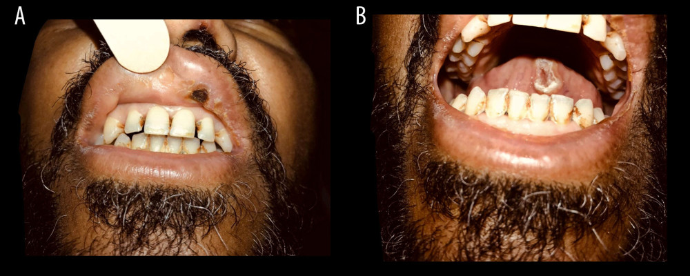 (A, B) Ecthyma gangrenosum. Necrotic erosions over the lips and tongue.