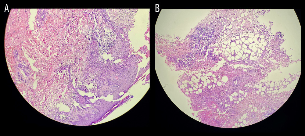 (A, B) Ecthyma gangrenosum histology. H&E staining of the skin (40×) shows epidermal necrosis and sloughing, sparse neutrophilic vasculitis that extends deeply into the subcutaneous tissue, and violaceous fibrinous debris surrounding the vascular wall.