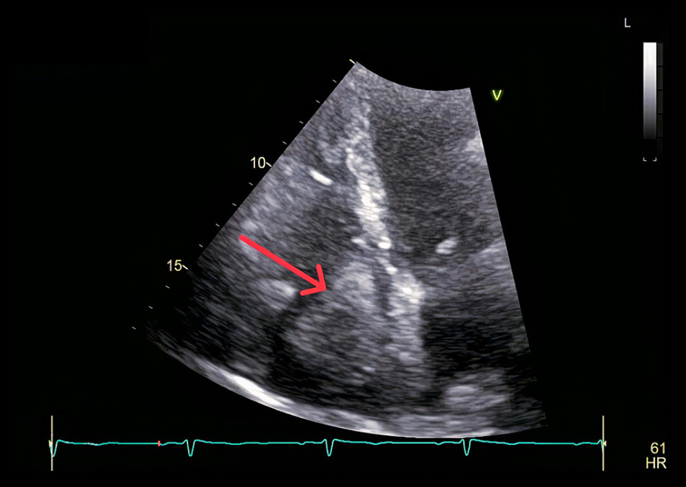 Transthoracic echocardiography showing a right atrial thrombus attached to the right atrial wall (red arrow).