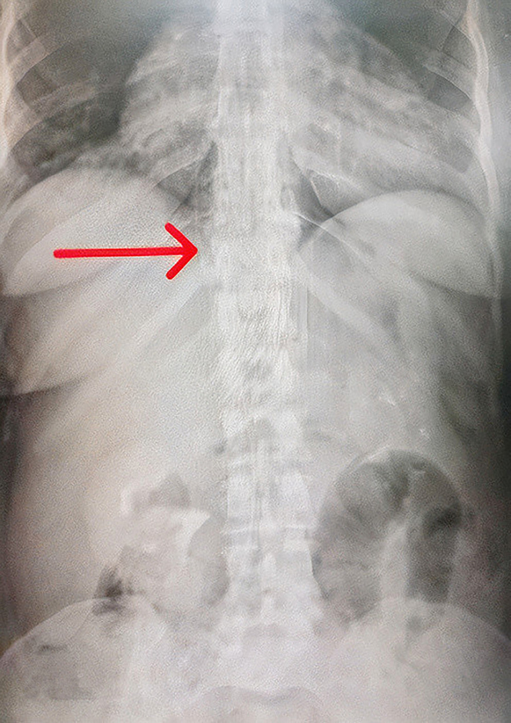 Abdominal X-ray showing the guidewire (red arrow) passing through the inferior vena cava.