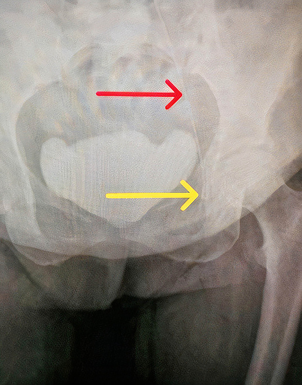 Abdominopelvic X-ray showing the guidewire (red arrow) ending with the hook of the guidewire (yellow arrow) reaching the femoral vein.