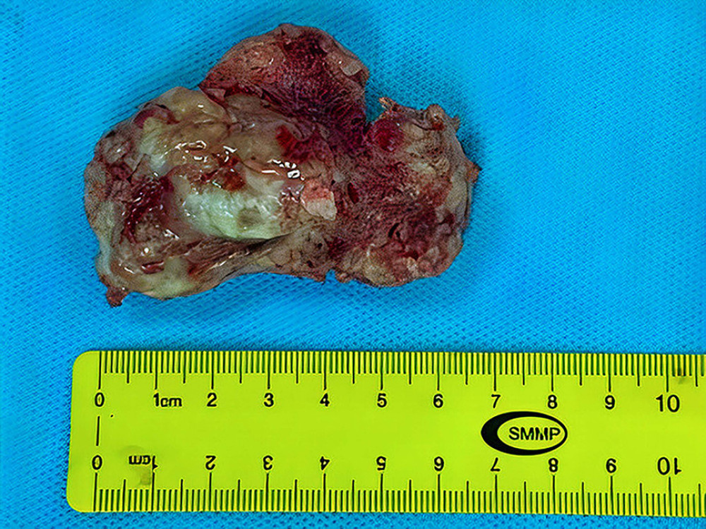 Excised right intra-atrial tumor measuring 6.5×4×2.5 cm.