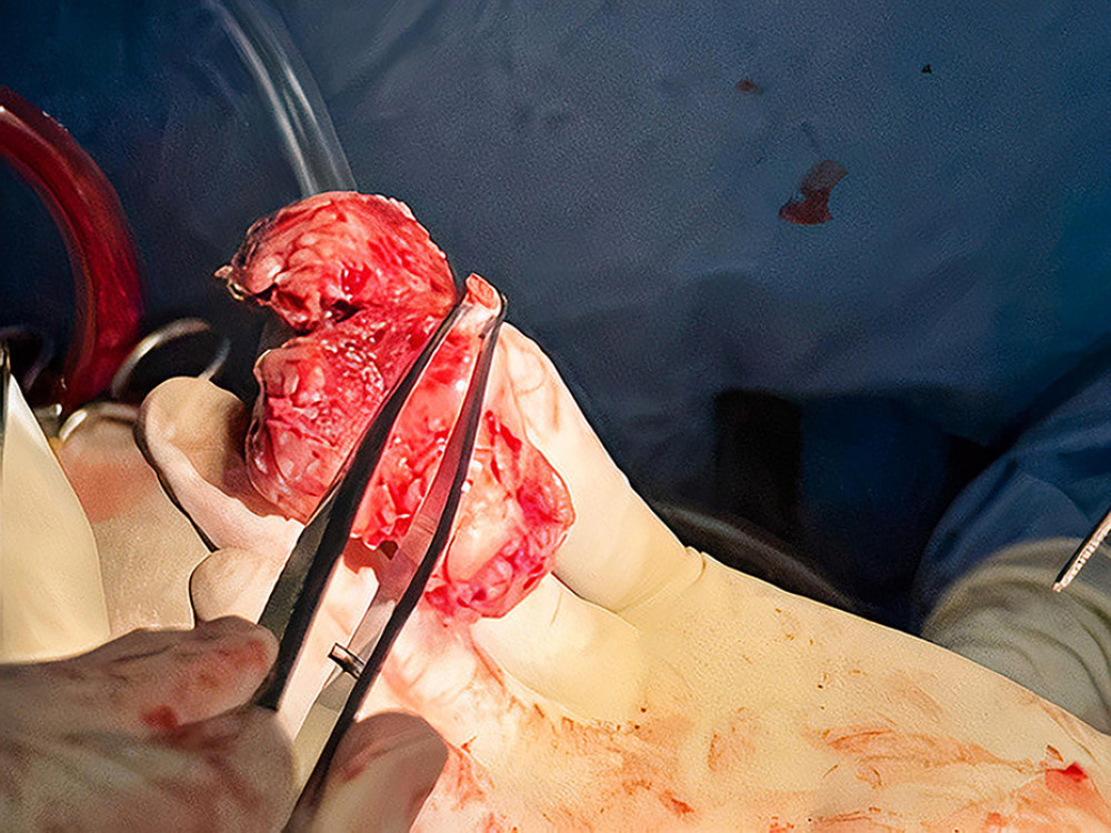 Intraoperative photo showing part of the guidewire within the excised right atrial mass.