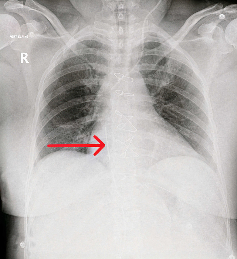 Postoperative chest X-ray showing endotracheal tube, sternotomy sutures, and newly inserted left internal jugular central venous catheter. A curvilinear radio-opaque shadow is seen at the left-upper quadrant, which is the remnant of the guide wire (red arrow).