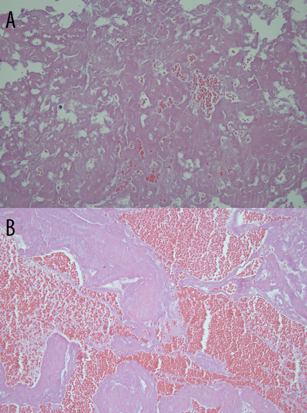 (A, B) A photomicrograph of the right atrial thrombus in a 47-year-old woman removed during open heart surgery. The histopathology shows degenerated fibrin, red blood cells suggestive of degenerated thrombus. Hematoxylin and eosin stain, ×400.