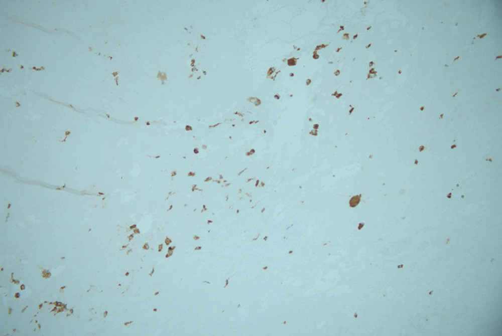 Immunohistochemical stain (DAKO) CD68: Positive for macrophages in granular tissue, ×400.