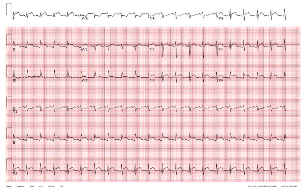 12-lead electrocardiogram (ECG) demonstrating sinus tachycardia with diffuse ST segment elevations and PR segment depressions, and PR segment elevation in lead aVR.