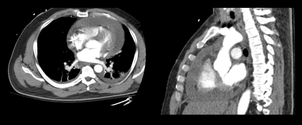 Axial and sagittal images through the heart and pericardium demonstrate a moderate-to-large pericardial effusion with possible mass effect on the cardiac chambers. On the axial image, an additional note is made of partially visualized left-greater-than-right pleural effusions with adjacent pulmonary parenchymal atelectasis.