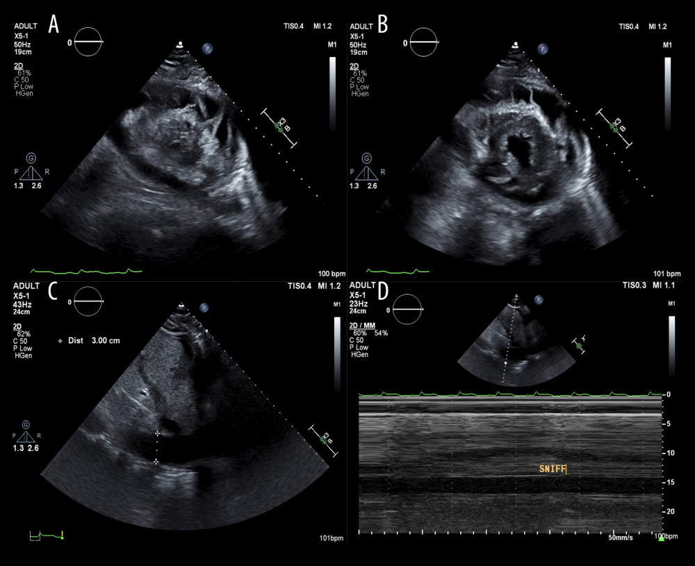 Transthoracic echocardiography images obtained. Panel A demonstrating short-axis view of the left ventricular apex with significant loculated pericardial effusion. Panel B demonstrating short-axis view of the mid-left ventricle with circumferential, loculated pericardial effusion. Panel C demonstrates the inferior vena cava distended to 3.0 cm [normal 1.5–2.5 cm], and panel D demonstrates no respiratory variation of the distended inferior vena cava, indicative of a central venous pressure of at least 15 mmHg [normal 8–12 mmHg].