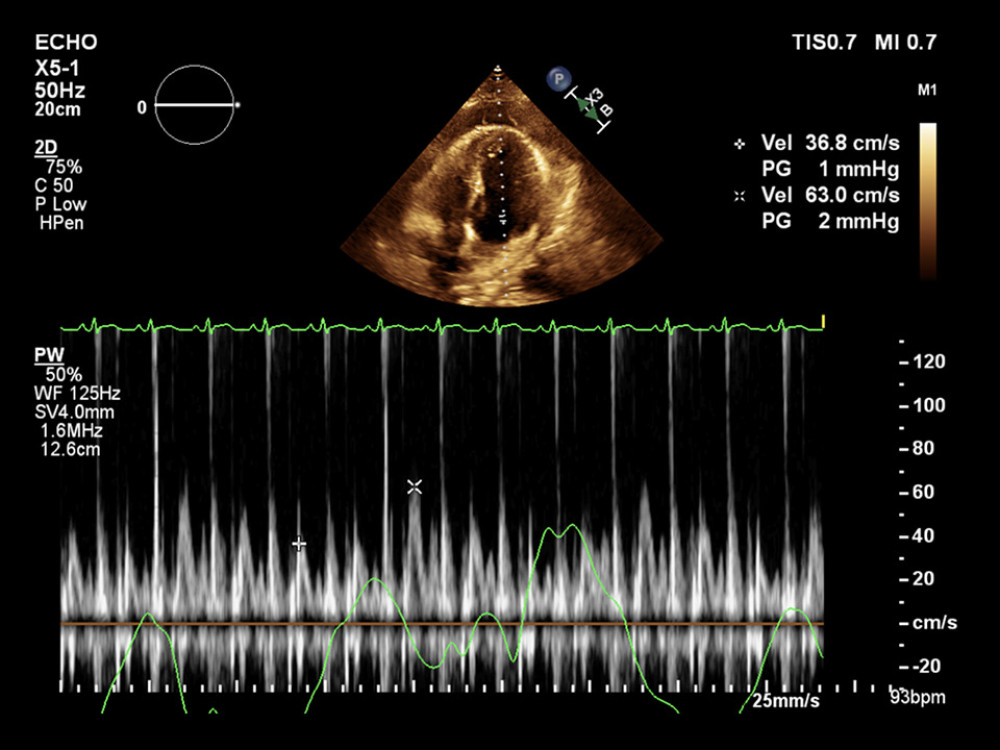 Mitral inflow pattern with significant respiratory variation of 41% (greater than 25%) consistent with tamponade physiology.