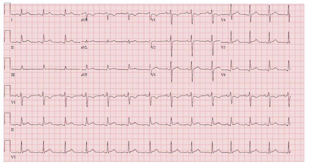 12-lead electrocardiogram (ECG) following pericardial window demonstrating resolution of sinus tachycardia and diffuse ST elevations.
