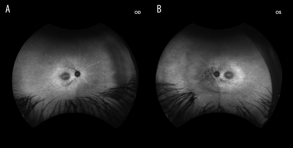 Fundus autofluorescence (FAF, 0.22×, Optos California) accentuates the classic bull’s eye maculopathy in the right eye (A) and left eye (B).