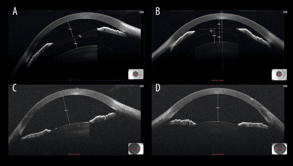 Anterior segment ocular coherence tomography (MS-39; Costruzione Strumenti Oftalmici, Italy) showing deepening of anterior chamber depth before ([A] right eye=1459 μm; [B] left eye=854 μm) and after ([C] right eye=2601 μm; [D] left eye=2447 μm) removal of implantable collamer lens (ICL) in both eyes. ICL thickness is 302 μm in the right eye (A) and 325 μm in the left eye (B). Vault (distance between ICL and crystalline lens) is 835 μm in the right eye (A) and 901 μm in the left eye (B).