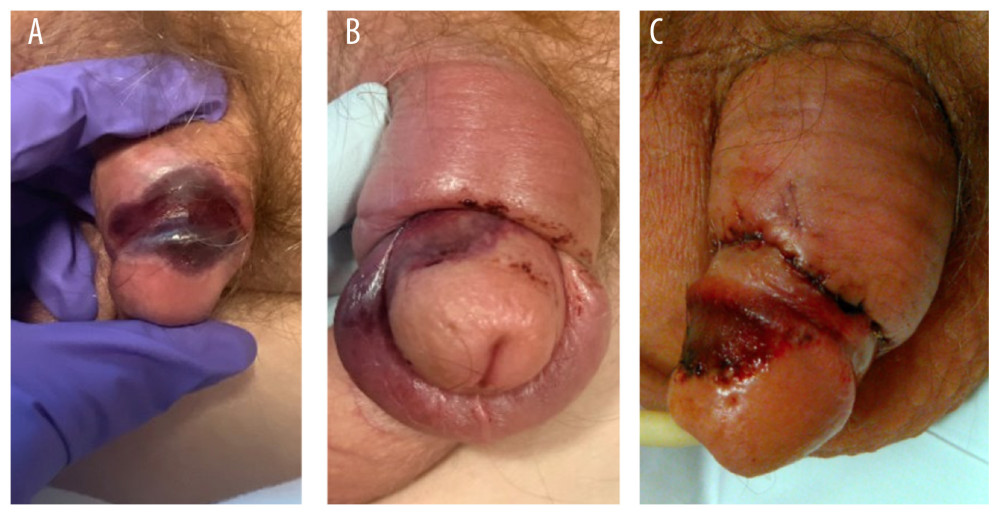 Evolution of the deeply violaceous macule on the corona of glans penis. (A) First encounter. (B) Day 3 and (C) Day 6 following debridement to bleeding, well-vascularized tissue.