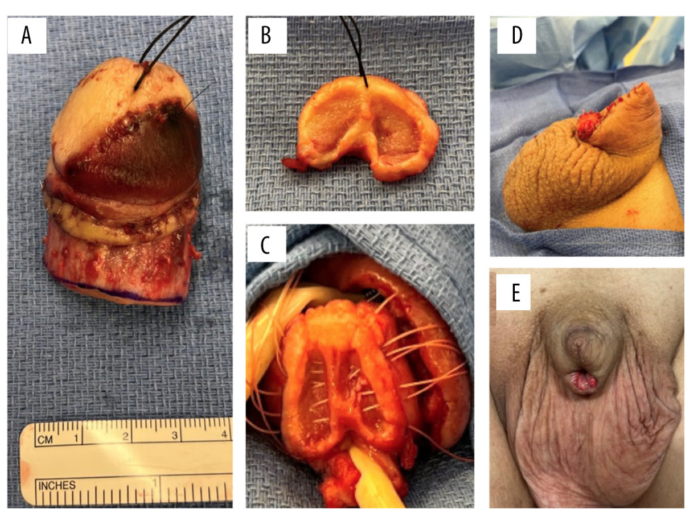 Intraoperative findings and postoperative exams. (A) Resected distal penis. (B) Cross-sectional corporal margin sent for frozen sectioning (urethra sent separately). (C) Penile stump with healthy margin prior to closure. (D) Penile stump at time of partial penectomy. (E) Penile stump 8 weeks postoperatively.