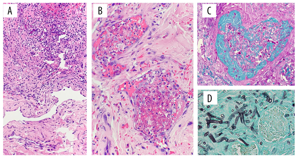 Histologic evaluation of the penis at the time of partial penectomy. (A) Fungal invasion (top) corpora spongiosum (bottom). (B) Angioinvasion with tissue necrosis. (C) Angioinvasion highlighted with periodic acid-Schiff light-green (PAS-LG) stain. (D) Broad ribbon-like non-septate hyphae with 90-degree branching (40× magnification) with Grocott’s methenamine silver (GMS) stain.