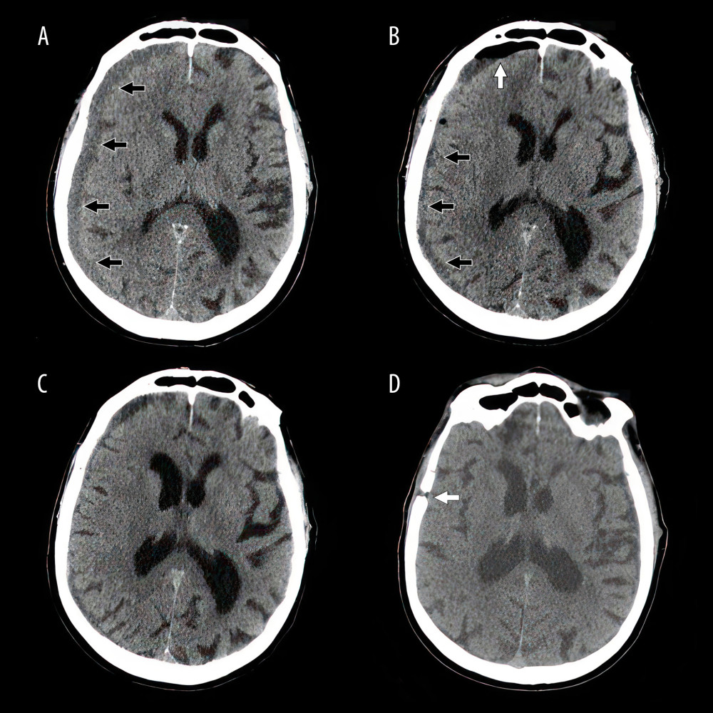 Pre- and postoperative imaging: sequential computerized tomography scans of the head (A) before surgery, (B) on the tenth postoperative day, and (C) 4 weeks after surgery, showing progressive resolution of the residual subdural collection (black arrows along the surface of the cerebral hemisphere). The white vertical arrow on image B shows residual intracranial air, a common and desirable feature early after surgical evacuation of a subdural hematoma. (D) Image performed 6 months later after the patient had a fall: the white arrow points to the site of the burr hole.