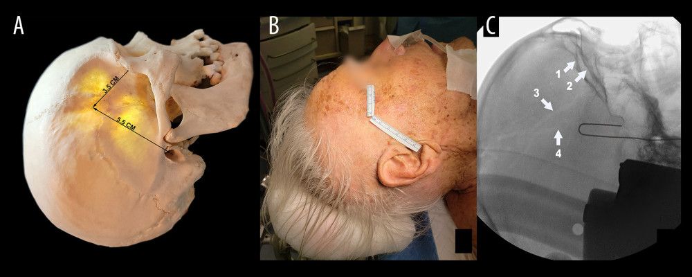 Intraoperative method used for localization of the middle meningeal artery (MMA): measurements to establish the zygomatic-meatal angle on (A) a human skull and (B) at the time of surgery. (C) Intraoperative fluoroscopic confirmation of the site of calvarial entry of the MMA. One should avoid a perfect lateral exposure by tilting the C-arm exposure, which separates the orbital roofs (arrows 1 and 2) as well as the contra-lateral (arrow 3) and ipsilateral grooves (arrow 4) for the MMA.