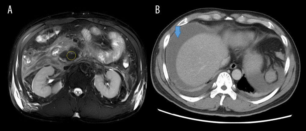 Enhanced computed tomography (CT) and magnetic resonance imaging (MRI) in Patient 1. (A) Abdominal MRI from Patient 1, which showed a mixed hematoma located between the pancreatic head and the descending duodenum (yellow circle). (B) Abdominal CT imaging from Patient 1, which showed extensive hematocele around the liver and abdominal pelvis (blue arrowhead).