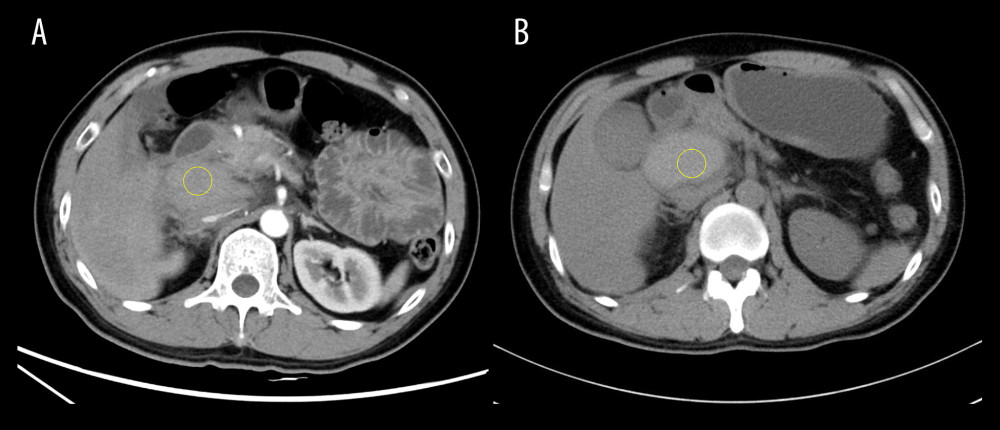 Enhanced computed tomography (CT) of Patient 2. (A) Abdominal CT imaging from Patient 2 on admission, which showed a small amount of peritoneal fluid and a hematoma located between the pancreatic head and the descending duodenum (yellow circle). (B) Abdominal CT imaging from Patient 2 after receiving 8 days of conservative treatment, which showed an enlarged hematoma between in pancreatic head and the descending duodenum, and accumulated gastric contents (yellow circle).