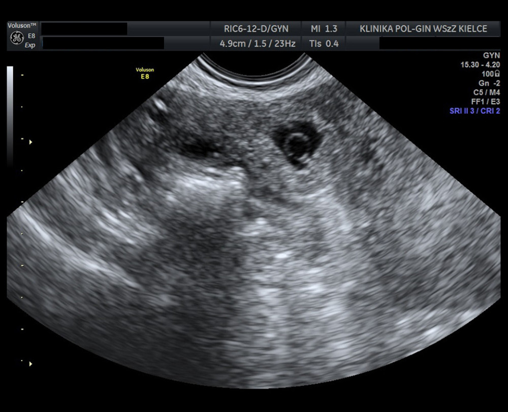 Ultrasound image showing an ectopic pregnancy on the day of admission. The scan shows a gestational sac containing a yolk sac.