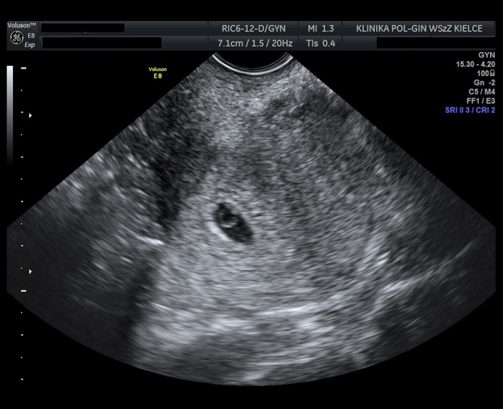 Ultrasound image showing an intrauterine pregnancy on the day of admission. The scan shows a properly located gestational sac within the uterine cavity with a yolk sac.