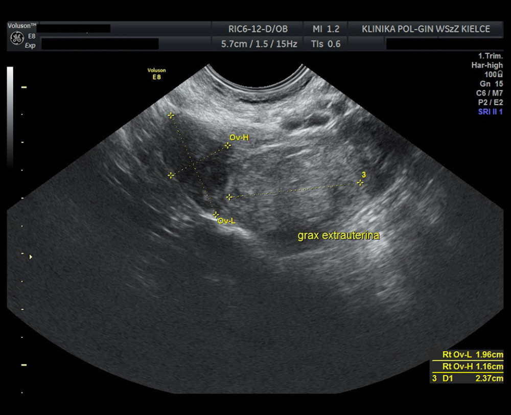 Ultrasound image showing an ectopic pregnancy on the seventh day after admission. The scan reveals a dilated fallopian tube with a mass representing the remnant of the regressed gestational sac within the tube. The adjacent ovary appears normal.