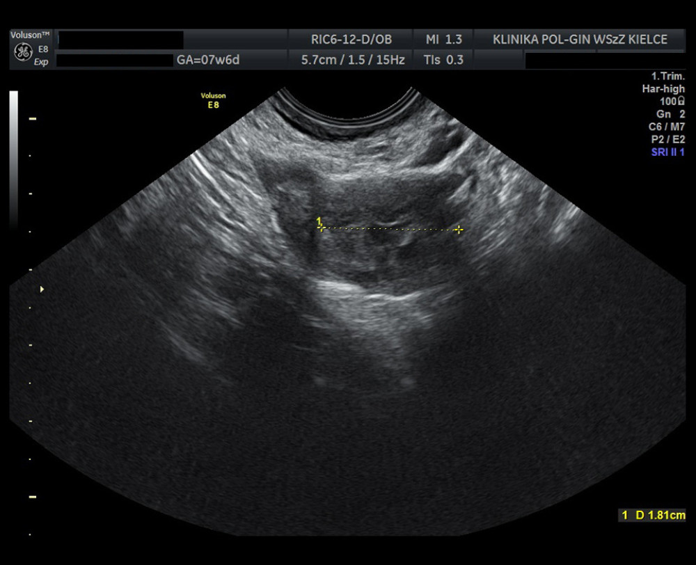 Ultrasound image showing an ectopic pregnancy on the seventeenth day after admission. The scan shows the fallopian tube with a reduced size of the mass compared with the previous scan (Figure 4).