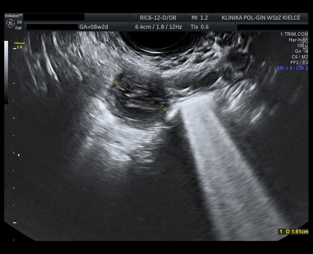 Ultrasound image showing an ectopic pregnancy on the twentieth day after admission. The scan demonstrates further regression of the abnormality within the fallopian tube.