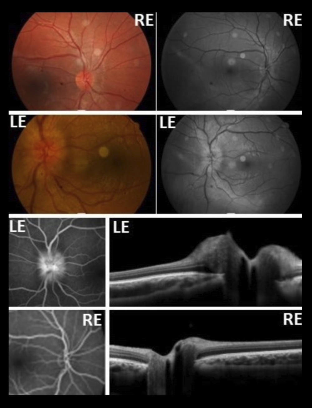 On retinography, papillary edema was only evident in the left eye (LE). Fluorescent angiography revealed hyperfluorescence with defocusing of the papilla in the LE, but in the right eye (RE) there was no change. Optical coherence tomography of the optic nerve quantitatively detected bilateral papillary edema (mild in the RE and severe in the LE).