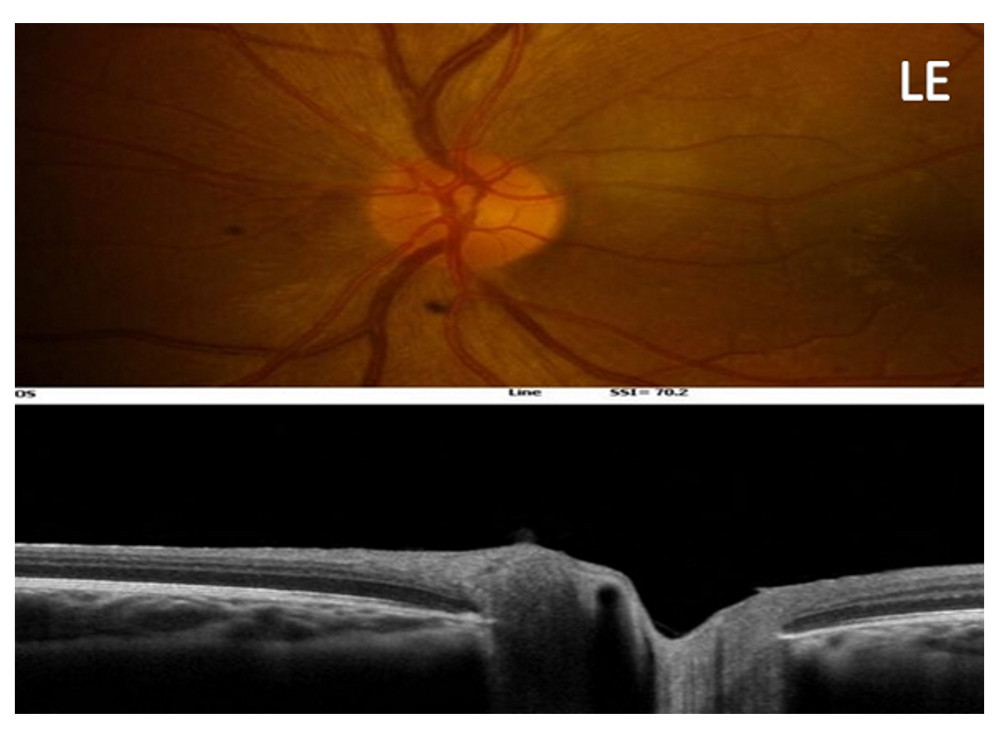 Resolution of the left eye (LE) papillary edema can be seen on retinography and optic nerve optical coherence tomography when the patient returned after taking prednisone 40 mg/day for 5 days.