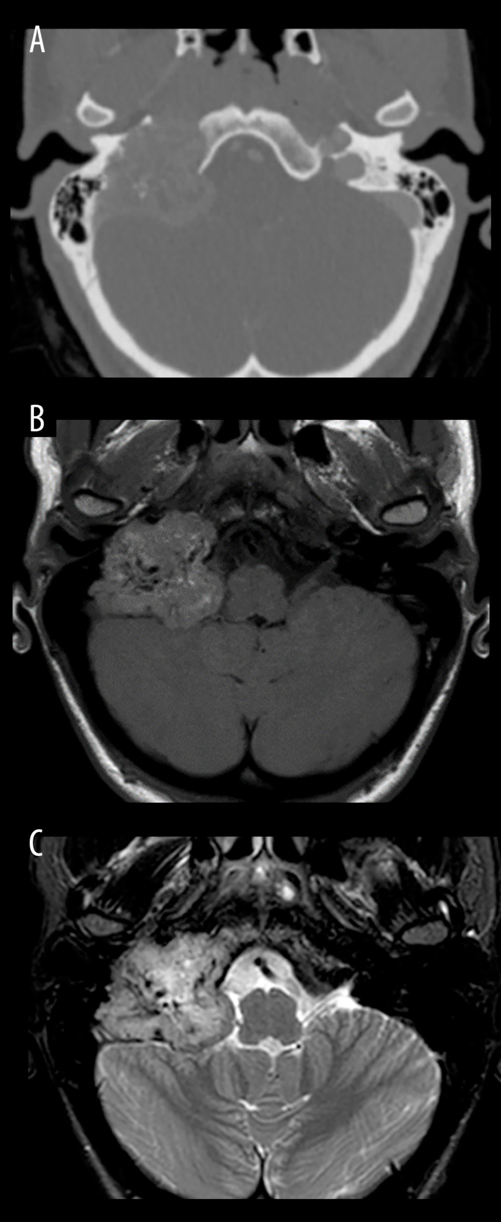 (A) Computed tomography image showing right soft-tissue mass lesion within the right temporal bone extending to the infra-temporal fossa and destruction of the temporal bone. (B) Magnetic resonant imaging (T1-weighted image) demonstrates a heterogenous soft-tissue mass lesion within the right temporal bone extending to the infra-temporal fossa and causing a mass effect on the right internal carotid artery and jugular vein and the right cerebellopontine angle. (C) Magnetic resonance imaging (T2-weighted image) demonstrates hyperintense mass with small low-signal flow voids (salt and pepper appearance).