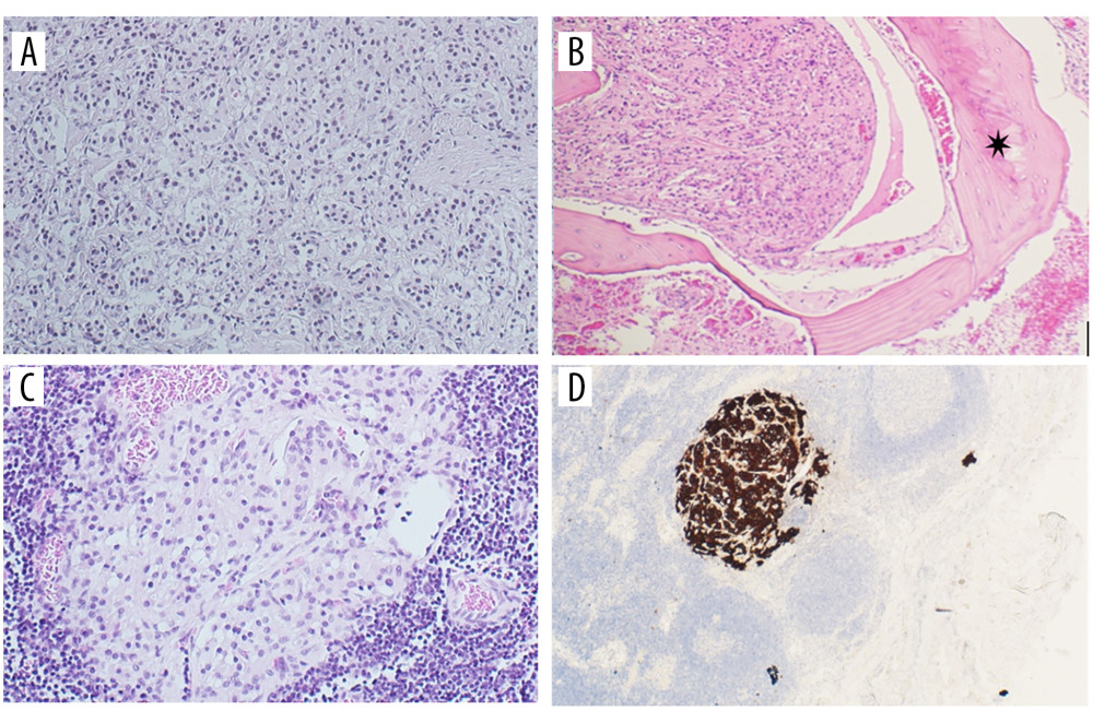 (A) A low-power magnification of the biopsy sample showing infiltrative epithelioid tumor forming a spindle and nesting pattern separated by fibrovascular stroma. (B) Tumor cells infiltrating the adjacent soft tissue and bone trabeculae (star). (C) Lymph node reveals a metastatic tumor nest. (D) Lymph node tumor nest highlighted by diffuse positivity for synaptophysin stain.