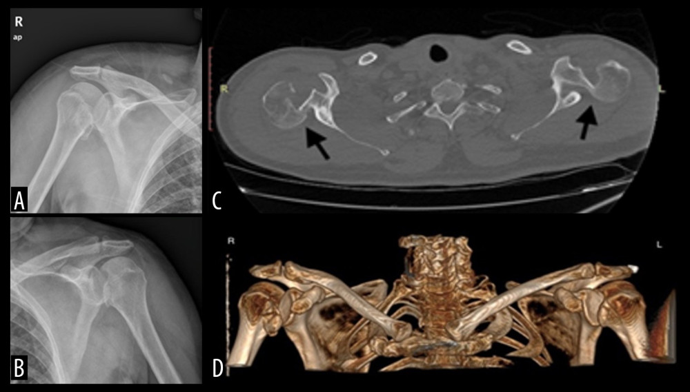 Preoperative, anteroposterior, right (A) and left (B) shoulder radiograph showing a posterior dislocation of the humeral head; (C, D). Preoperative axial CT view and 3D reconstructions confirming the bilateral posterior fracture-dislocations and the presence of a reverse Hill-Sachs lesion.