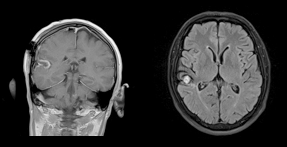 MRI images showing the presence of a cavernous hemangioma.