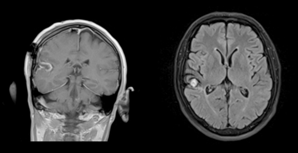 MRI images showing the presence of a cavernous hemangioma.
