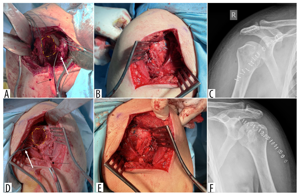 (A) Intraoperative picture of the right shoulder. The yellow doted area demonstrates the humeral head defect (reverse Hill-Sachs lesion), the black arrow shows the tenotomized biceps, and the white arrow indicates the subscapularis tendon with the detached lesser tuberosity. (B) Intraoperative picture of the right shoulder after the modified McLaughlin procedure. (C) Postoperative anteroposterior radiograph of the right shoulder demonstrating a reduced humeral head. (D) Intraoperative picture of the left shoulder. The yellow doted area demonstrates the humeral head defect (reverse Hill-Sachs lesion), the black arrow shows the tenotomized biceps and the white arrow indicates the subscapularis tendon tagged with Ethibond sutures just before reduction. (E) Intraoperative picture of the left shoulder after the modified McLaughlin procedure. (F) Postoperative anteroposterior radiograph of the left shoulder demonstrating a reduced humeral head.