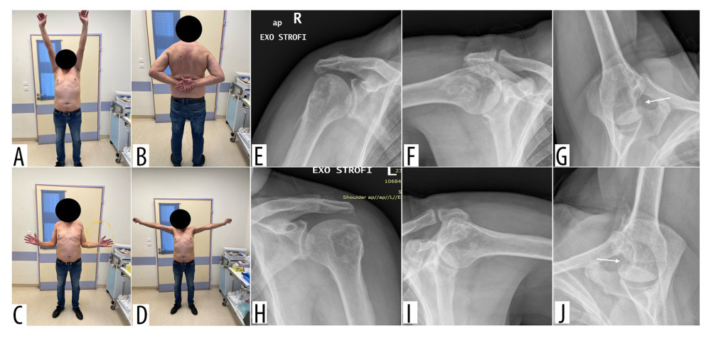 (A–D) Range of motion 18 months postoperatively and follow-up radiographs of the right (E–G) and left (H–J) shoulder. Note the remaining reverse Hill-Sachs lesion in both shoulders (white arrows).