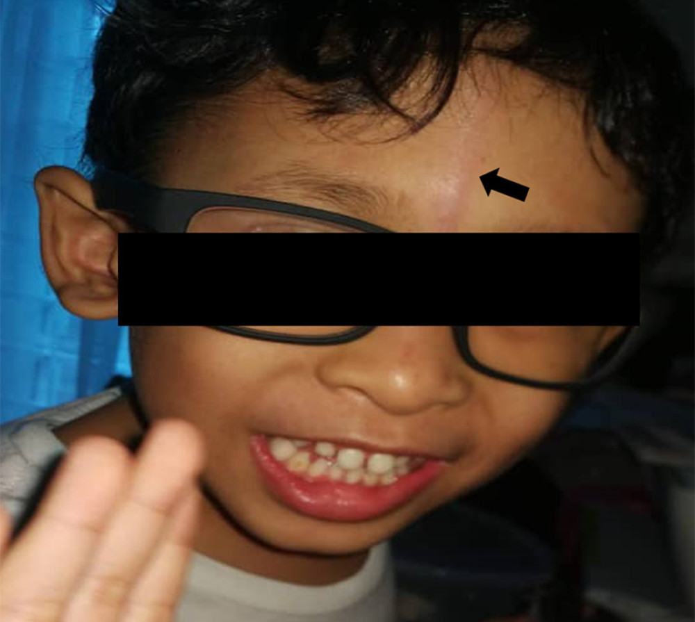 Linear purplish-grey rash over forehead which extending downward from hairline to the nasal bridge.