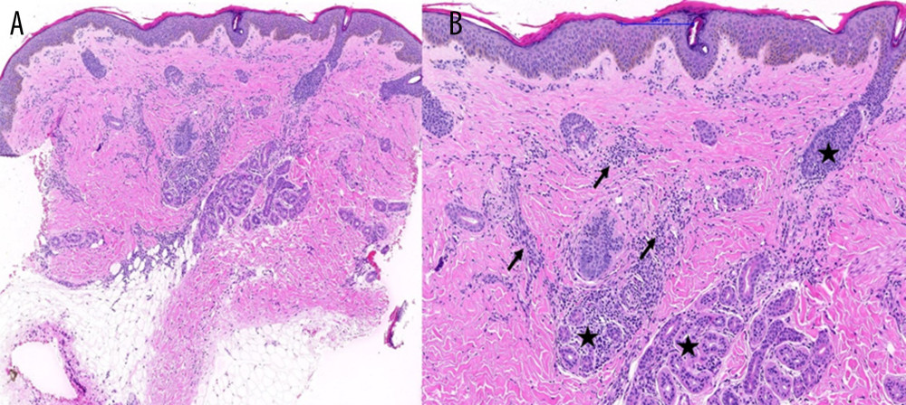 Section from the punch skin biopsy shows rigid, squared silhouette at low power (A) (hematoxylin and eosin stain, original magnification ×50). Moderate perivascular (arrow) and periadnexal (star) inflammatory cells infiltrate are seen (B) (hematoxylin and eosin stain, original magnification ×100).