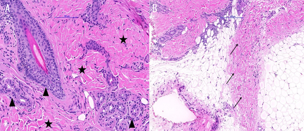 Thickened collagen bundles (star) within reticular dermis are shown, as well as early loss of periadnexal fat (arrowhead) (A) (hematoxylin and eosin stain, original magnification ×200). Mild septal panniculitis is observed, resulting in widening and thickening of the fat septa (arrow) (B) (hematoxylin and eosin stain, original magnification ×100).