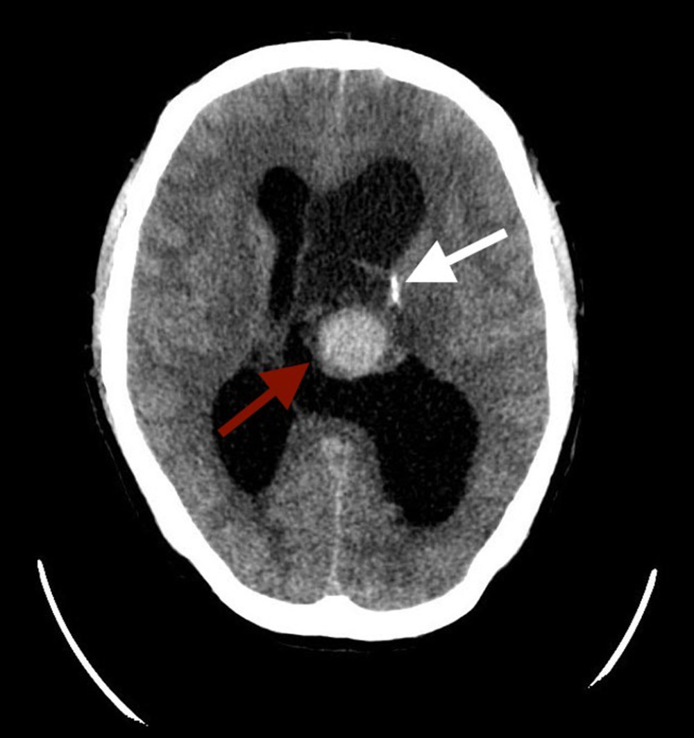 CT of the head, axial reconstruction, showing a mass of non-homogeneous density in the left lateral ventricle (red arrow), with a component of a hemorrhage. Focal calcification on the lateral side of the tumor can be seen (white arrow). CT – computed tomography.
