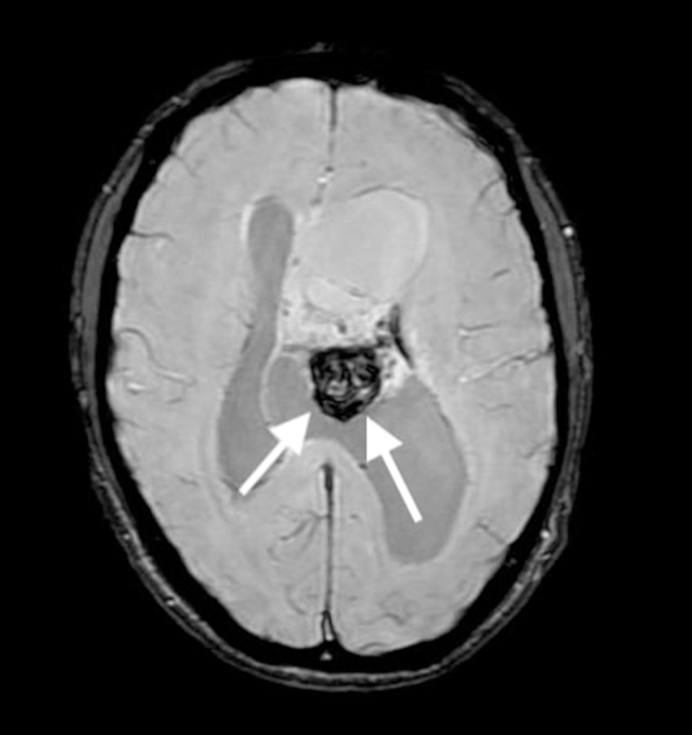 MRI of the head, SWI sequence, axial plane. A solitary lobulated mass is centered in the left lateral ventricle close to the foramen of Monro, with heterogeneous signal, visually well-demarcated, and with central hemorrhage (white arrows). MRI – magnetic resonance imaging; SWI – susceptibility weighted imaging.