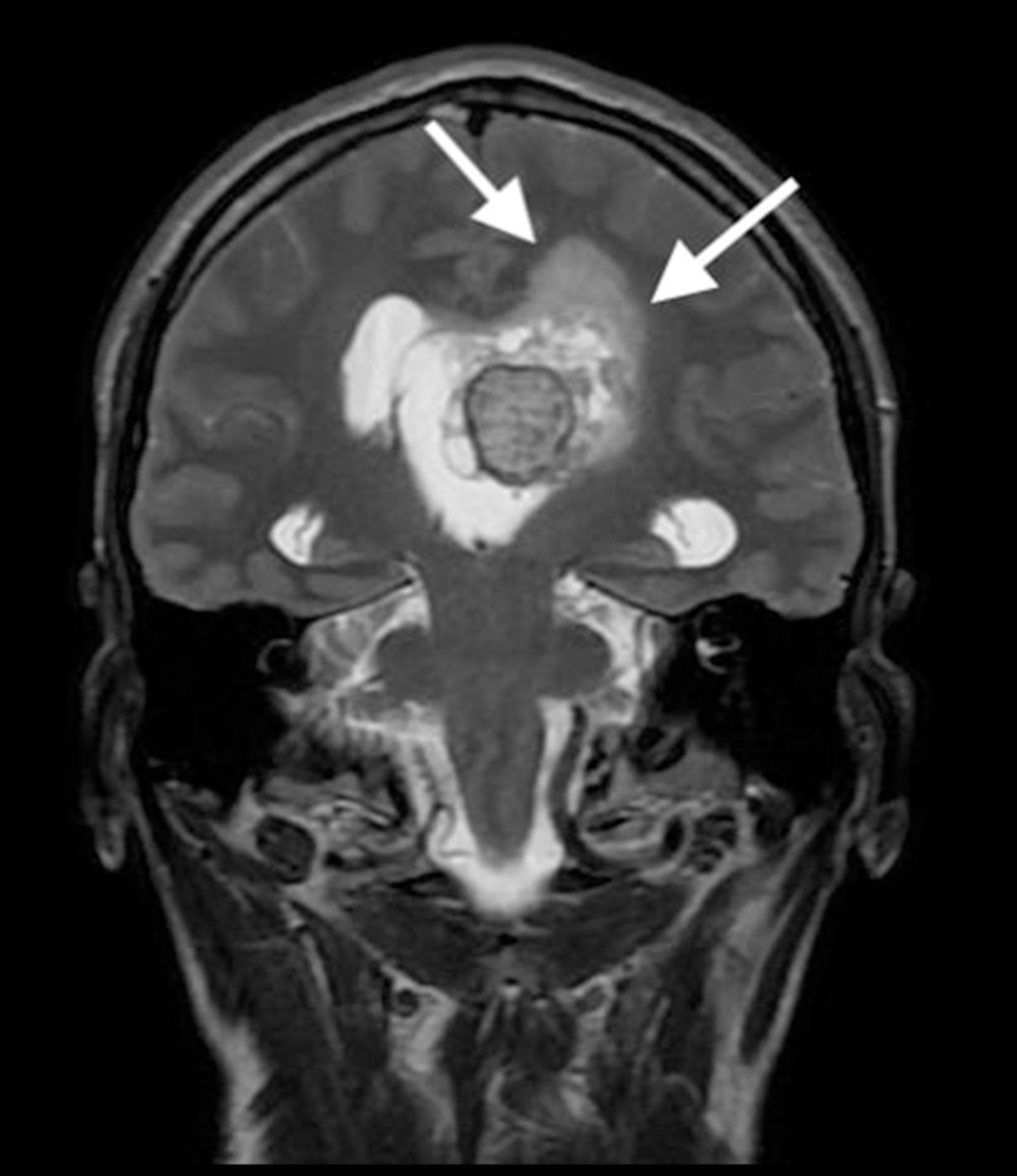 MRI of the head, T2WI sequence, coronal plane. There is edema in the periventricular white matter, around the left lateral ventricle (white arrows). MRI – magnetic resonance imaging.