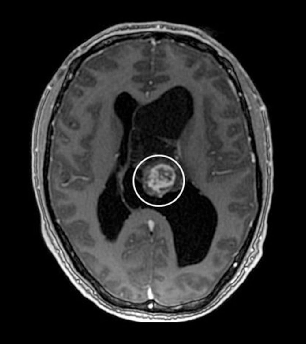 MRI post-contrast T1WI sequence of the head, axial plane. A central component of the tumor demonstrates intense enhancement in a point-like manner. MRI – magnetic resonance imaging.