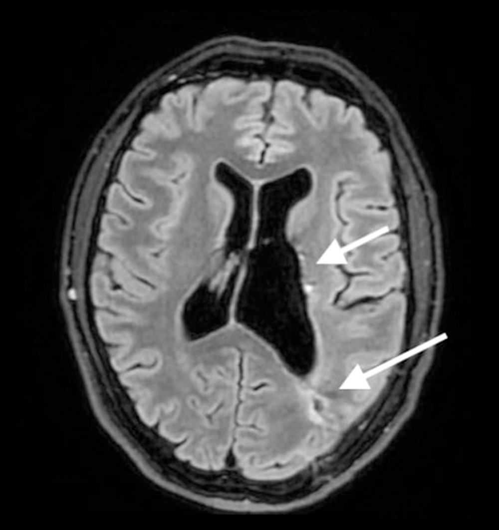 Postoperative MRI FLAIR sequence of the head, axial plane. No sign of any residual tumor tissue in the left ventricle or brain tissue can be seen. Postoperative scar tissue can be visualized (white arrows). MRI – magnetic resonance imaging; FLAIR – fluid-attenuated inversion recovery.