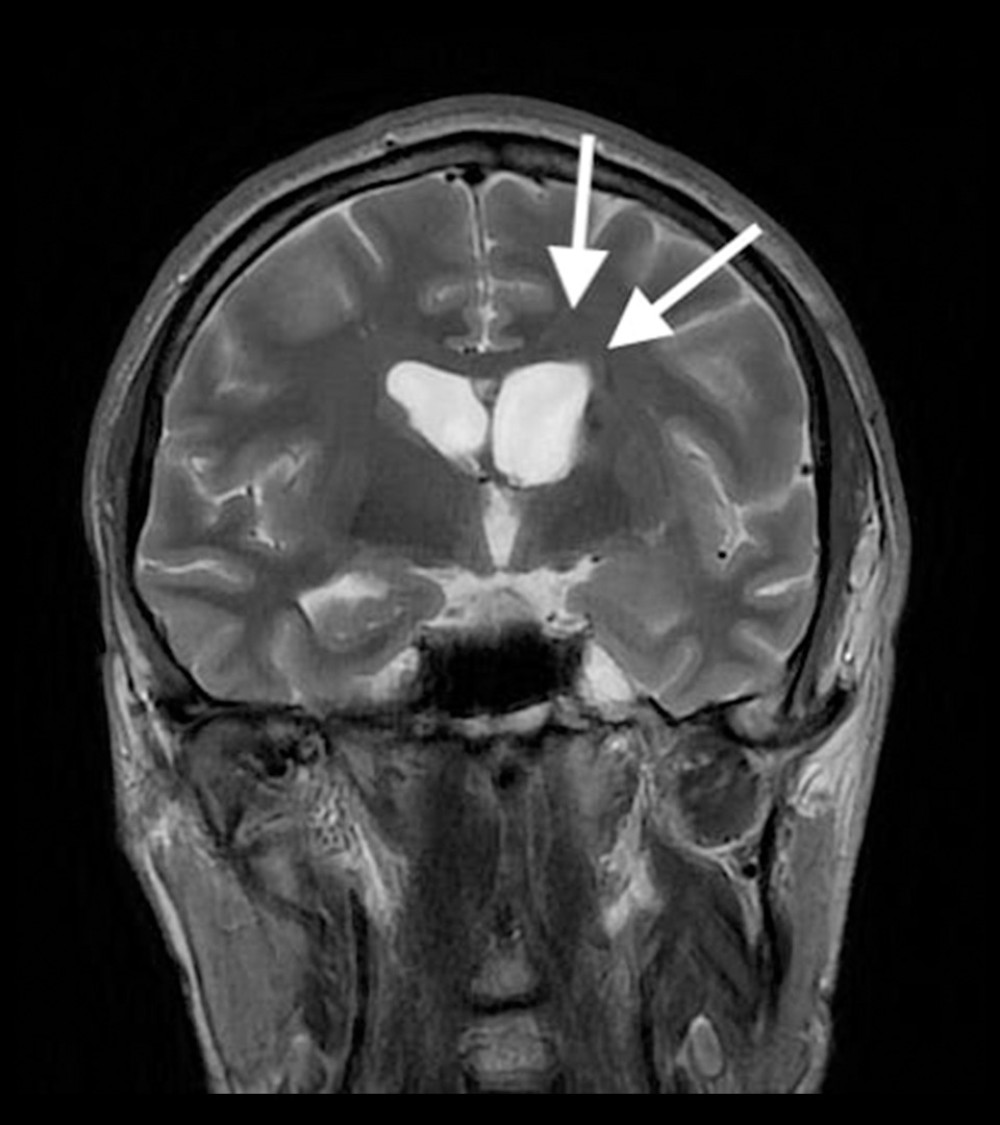 Postoperative MRI, coronal T2WI sequence of the head shows periventricular white matter edema that has considerably decreased (white arrows). MRI – magnetic resonance imaging.